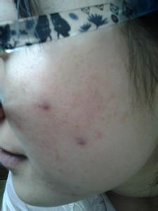 皮炎平可以涂在脸上吗 皮炎平可以涂在脸上吗 脸可以涂皮炎平吗?