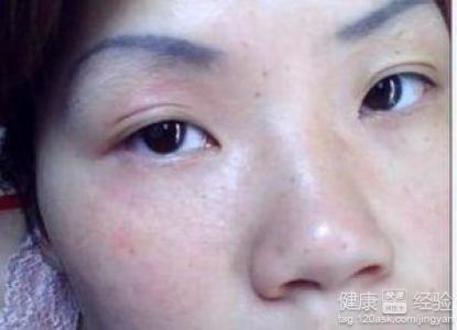 皮肤过敏能不能吃芒果 皮肤过敏能不能吃辣 三点原因分析