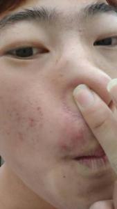 鼻孔门口长痘痘 鼻子旁边长痘痘的原因是什么