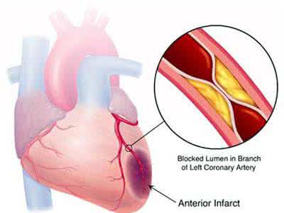 高血压冠心病能活多久 高血压与冠心病