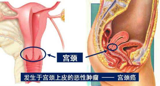 同房接触性出血 接触性出血是怎么了 同房后阴道出血怎么回事