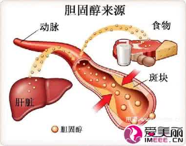 胆固醇结石如何治疗 胆固醇高的症状 胆固醇的治疗与食物选择