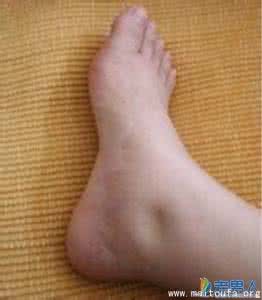 老人脚肿是怎么回事 疾病预防 老年人脚肿是怎么回事 老人脚肿是身体有病症