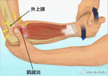 治疗网球肘中药 中药外敷治疗肱骨外上髁炎（网球肘）