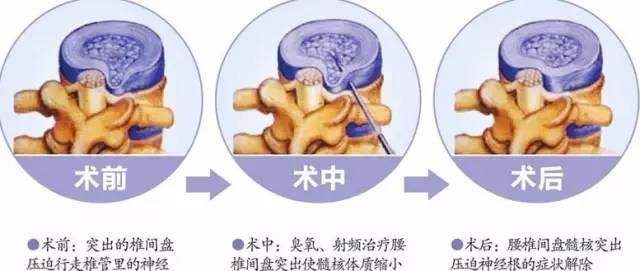 腰间盘膨出最佳治疗 腰椎间盘膨出怎么治疗