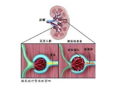 如何治疗糖尿病肾病 糖尿病肾病治疗 如何治疗糖尿病肾病