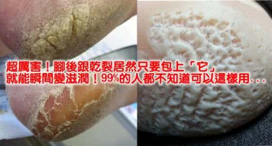 脚后跟干裂怎么办 超厲害！腳後跟乾裂居然只要包上「它」就能瞬間變滋潤！99%的人都不知道可以這樣用...