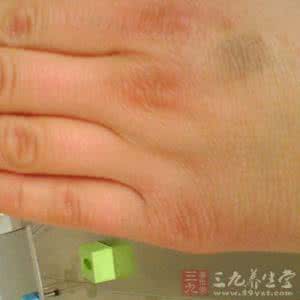 女性红斑狼疮早期症状 红斑狼疮的症状 女性朋友需注意