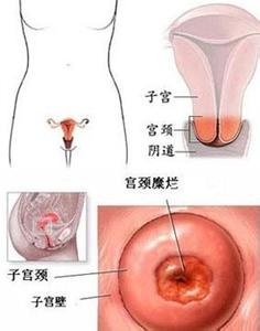 宫颈糜烂会引起不孕吗 阴道炎可能引起宫颈糜烂吗