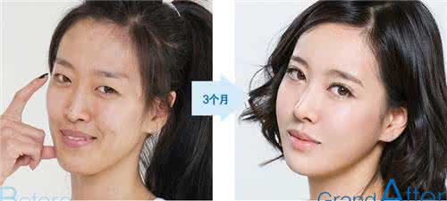 丰额头手术 韩国丰额头手术方法 隆额头的手术方法是怎样的