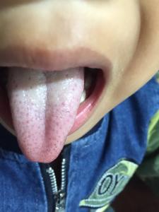 舌苔白厚吃什么药 舌苔白厚吃什么药治疗 舌苔白厚的治疗方式