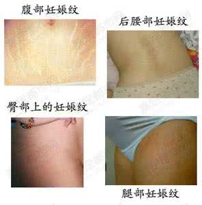 孕期如何防止妊娠纹 妊娠线 如何防止妊娠纹