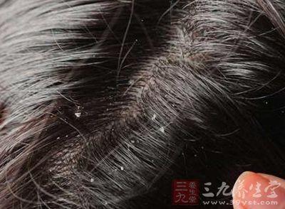 头发油头皮屑多怎么办 头皮屑严重 头皮出油头屑严重 该怎么调理