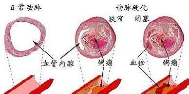 动脉硬化闭塞症治疗 动脉硬化闭塞症 如何治疗动脉硬化闭塞症