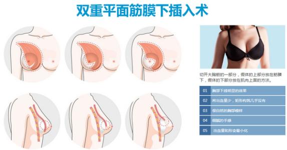 隆胸假体取出 隆胸假体取出 隆胸假体取出方法介绍