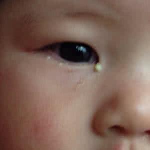 眼屎多是怎么办 什么是眼屎  眼屎多是怎么办