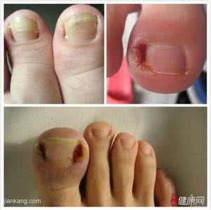 干细胞治疗银屑病 脓胞型银屑病的治疗 主要还是靠药物治疗