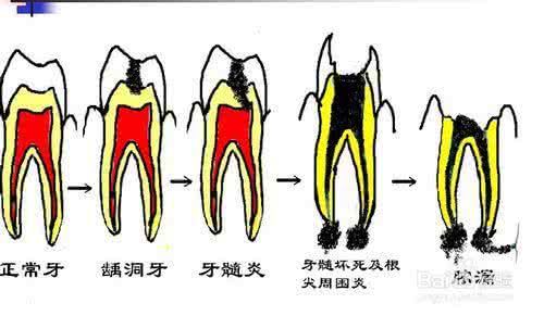 快速止牙疼的妙招 妙招帮你分分钟止牙疼，各种牙齿问题你属于哪种？