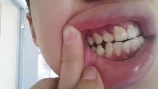 牙齿变长牙龈萎缩 牙齿与牙龈有缝隙 牙齿间缝隙变大，是牙龈萎缩了，简单方法，一招解决