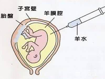 羊水穿刺危险吗 羊水穿刺危险大吗？