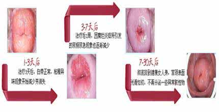 重度宫颈糜烂几年癌变 宫颈糜烂会癌变吗 女性保健 什么情况下宫颈糜烂会癌变