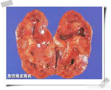 妊娠合并急性肾盂肾炎 妊娠合并肾盂肾炎 妊娠合并急性肾盂肾炎