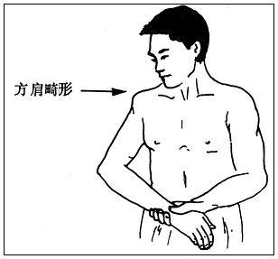 畸形精子症求民间偏方 方肩畸形