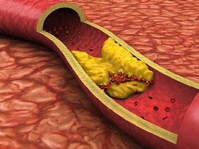 动脉硬化的中医治疗 动脉硬化的中医按摩治疗