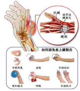 手腕腱鞘炎 腱鞘炎