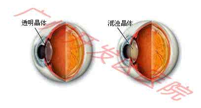 白内障形成原因 白内障形成原因 5个细节败坏你的眼