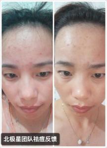 右脸颊长痘痘原因 两边脸颊长痘痘的原因是什么 科学祛痘妙招帮你消痘