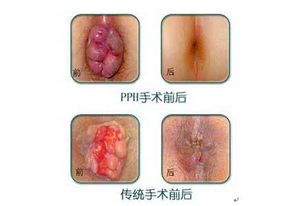 治疗痔疮的最好办法 痔疮好治吗 痔疮的各种治疗手段