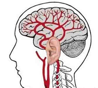 脑血栓前兆 教你留意脑血栓前兆 6个表现暗示脑部栓塞