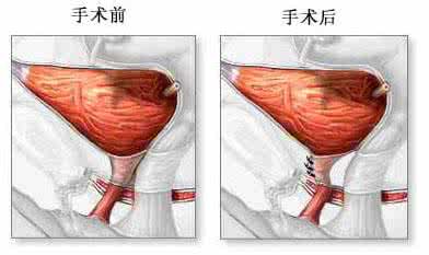 下肢瘫痪 搬重物引起下肢瘫痪，快速手术后恢复行走：一例少见的胸椎管内出血病例分析