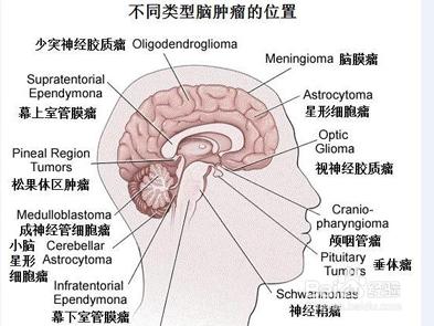 小儿颅内肿瘤 颅内缺血灶是什么原因 小儿颅内肿瘤的原因是什么