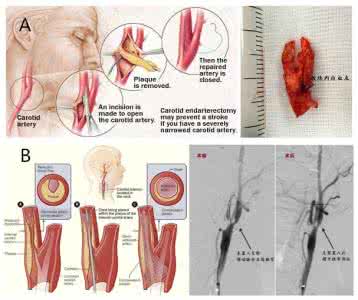 颈动脉斑块怎么办 颈动脉斑块怎么办 【疾病诊疗】关于颈动脉斑块,你应该跟患者如此解释