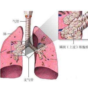 肺癌吃什么食物抗癌 图文：令人震惊的防癌、抗癌、治愈肺癌的科学妙法（最好的）