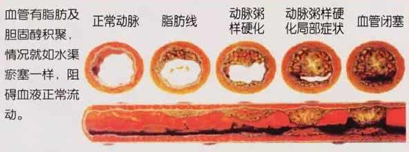 血管活性物质 六月吃一物 血管再也不堵了