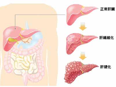 贺瑾怎么会得肝硬化 怎么会得肝硬化？