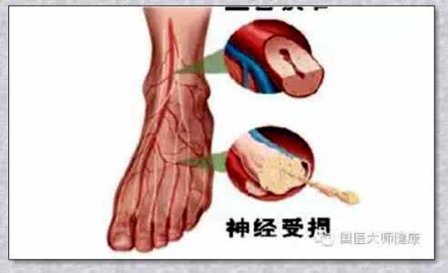 全身血管堵塞 血管堵了，全身遭殃！你需要吃点“血管清道夫”来帮忙！