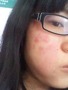 化妆品过敏投诉处理 化妆品过敏投诉处理 【化妆品过敏怎么办】化妆品过敏怎么处理