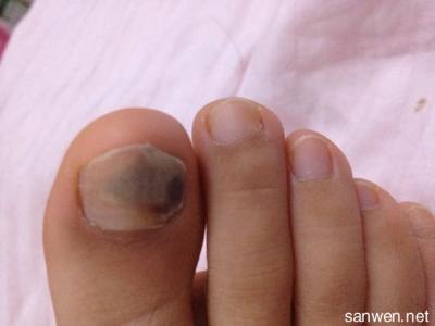 灰指甲最佳治疗方法 灰指甲最佳治疗方法 灰指甲的用药治疗 最佳的治疗方法