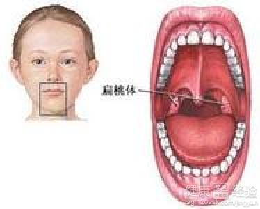 扁桃体发炎该怎么办 孩子扁桃体发炎 孩子扁桃体发炎该怎么办
