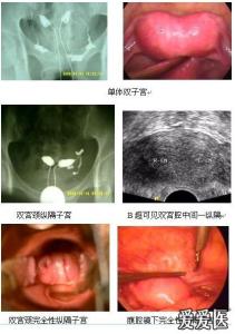 双角子宫怎么办 先天性双角子宫畸形怎么办？