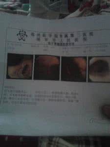 胃出血吃云南白药粉 胃出血云南白药怎么吃 胃出血该怎么吃