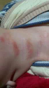 皮肤过敏好转的症状 皮肤过敏好转的症状 过敏源-发病-抗过敏治疗-症状好转-过敏源-发病