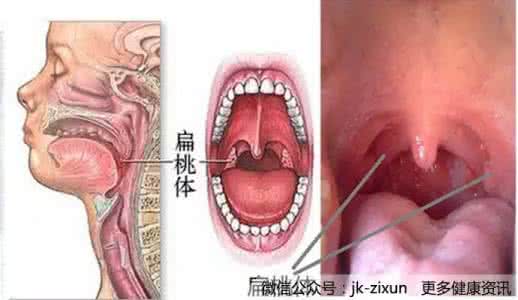 扁桃体发炎偏方 再也不会扁桃体发炎