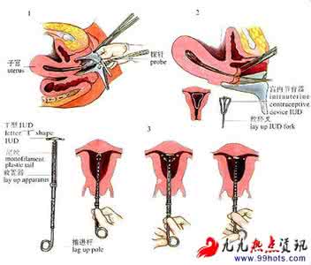 有图有真相 揭秘古今中外女性避孕怪招(有图有真相)