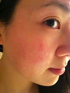 全身皮肤过敏怎么办啊 皮肤过敏症状怎么办