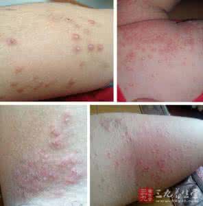 二手车知识大讲堂 湿疹系列知识大讲堂